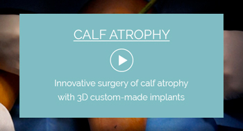 Calf atrophy surgery with implant technique video