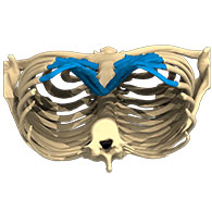 3D-Ansicht eines Pectus Excavatum - typ 1