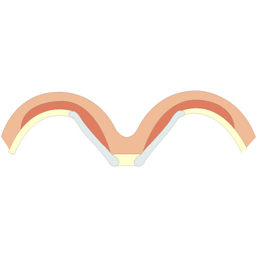 Zeichnung von Pectus Excavatum - typ 1