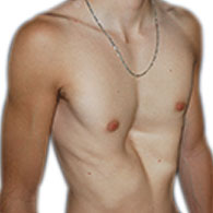 Pectus Excavatum beim Menschen - typ 1