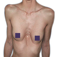 Pectus Excavatum bei Frauen - typ 1