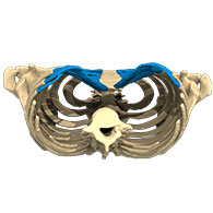 3D-Ansicht eines Pectus Excavatum - typ 2