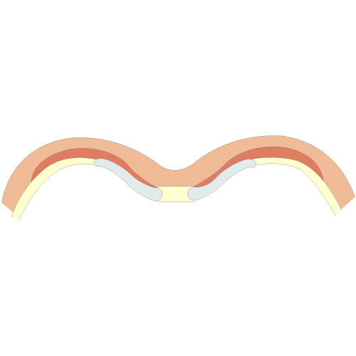 Zeichnung von Pectus Excavatum - typ 2