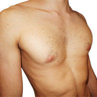 Pectus Excavatum beim Menschen - typ 2