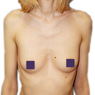 Pectus Excavatum bei Frauen - typ 2