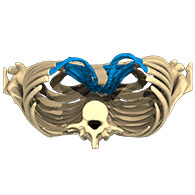 3D-Ansicht eines Pectus Excavatum - typ 3