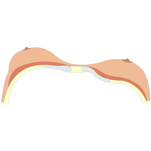 Zeichnung von Pectus Excavatum - typ 3