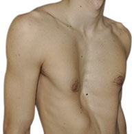 Pectus Excavatum beim Menschen - typ 3