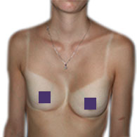Pectus Excavatum bei Frauen - typ 3