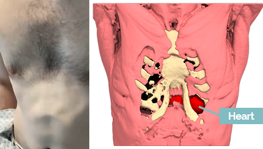 Erfolglose Ravitch-Korrektur bei Pectus Excavatum mit sichtbarem Herzspitzenstoß in der Realität und im 3D-Design