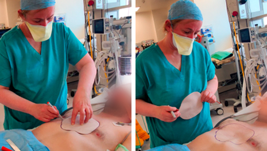 Prof. Redmond macht die Prototypmarkierungen auf dem Patienten für die Pectus Excavatum-Redo-Operation mit 3D-Implantaten