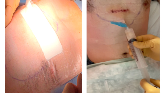 Wundtherapie nach Pectus-OP und Serompunktion