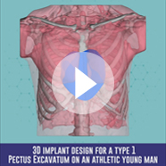 Pectus Excavatum surgery with implant technique video