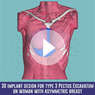 Pectus Excavatum surgery with implant technique video