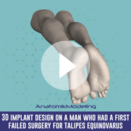 Pectus Excavatum surgery with implant technique video
