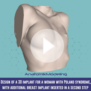 Pectus Excavatum surgery with implant technique video