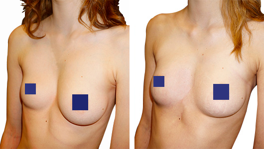 Résultat Avant/Après correction par Implant Pectus Asymétrie Mammaire