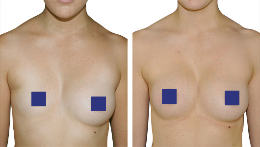 Résultat Avant/Après correction par Implant Pectus Asymétrie Mammaire