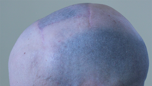 Résultat d'une cranioplastie