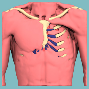 Poland Syndrom 3D design