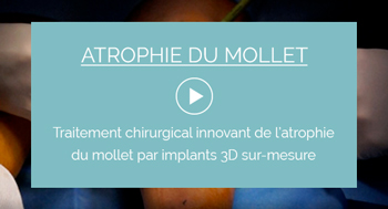 Vidéo Chirurgie de l'atrophie du mollet  par implant 3D sur-mesure
