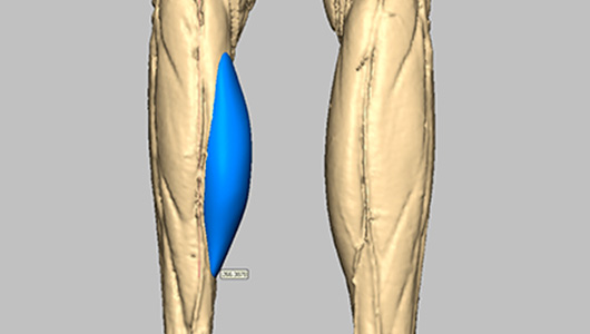 Wadenatrophie Silikonimplantat