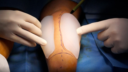Wadenatrophieoperation