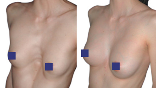 Ergebnis vor nach Pectus Excavatum frau