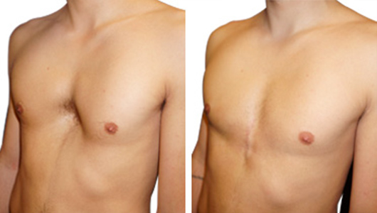 Ergebnis vor nach pectus excavatum mann
