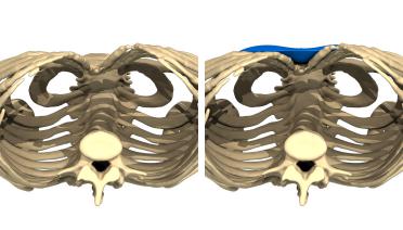Frau - Trichterbrust typ 3 - 3 Monate später - 3D-Ansicht