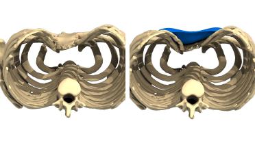 Mann - Trichterbrust typ 1 - 1 Jahr später - 3D-Ansicht