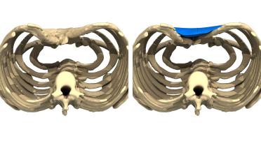 Mann - Trichterbrust typ 2 - 3 Monate später - 3D-Ansicht