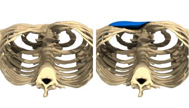 Mann - Trichterbrust typ 3 - 3 Monate später - 3D-Ansicht