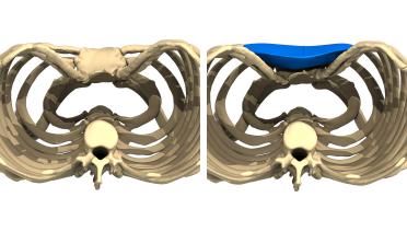 Mann - Trichterbrust typ 4 - 1 Jahr später - 3D-Ansicht