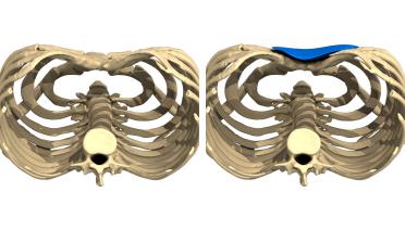 Mann - Trichterbrust typ 5 - 1 Jahr später - 3D-Ansicht